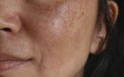 woman with oily skin type smiling